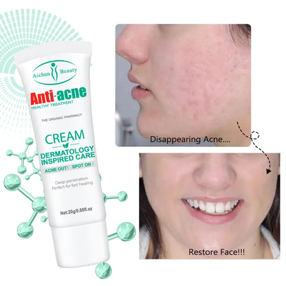 Crema Anti acné Aichun Beauty #CodL
